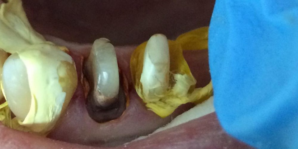 Восстановление разрушенных зубов 1.4, 1.5 - фото №1