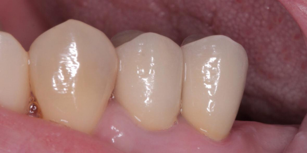 Восстановление разрушенных зубов 1.4, 1.5 - фото №4