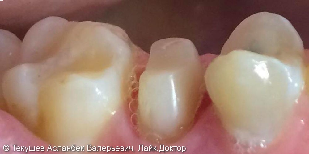 Восстановление сильно разрушенного зуба керамической коронкой Емакс - фото №1