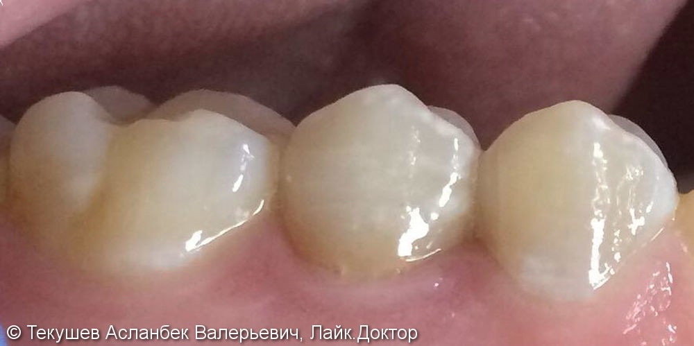 Восстановление сильно разрушенного зуба керамической коронкой Емакс - фото №4