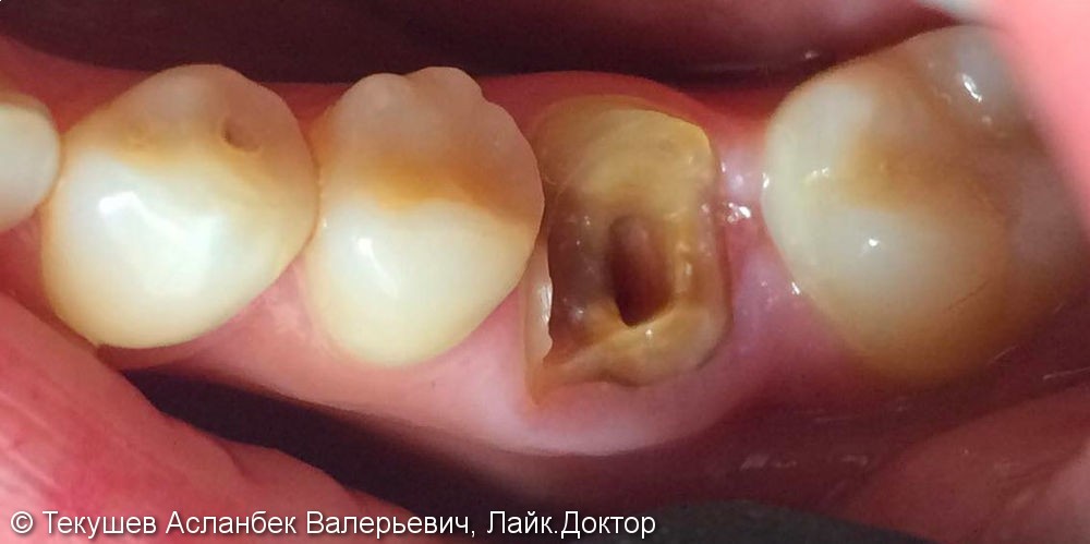 Восстановления зуба, которые мало кто восстанавливает, в связи с поддесневым дефектом - фото №1
