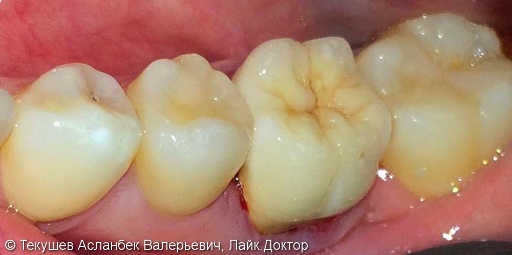 Восстановления зуба, которые мало кто восстанавливает, в связи с поддесневым дефектом - фото №2