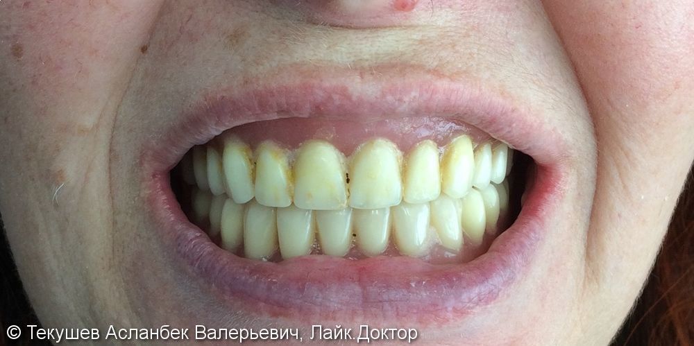 Восстановление улыбки с помощью имплантов и керамических коронок - фото №1