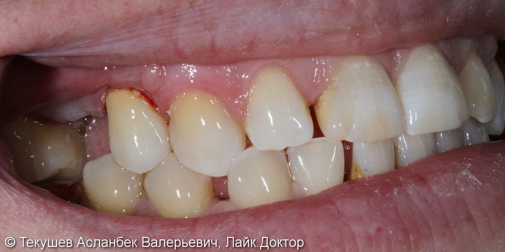 Керамическая коронка в цвет своих зубов после перелома коронковой части зуба - фото №1