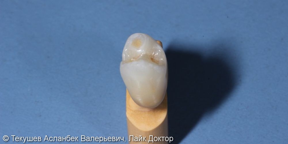 Керамическая коронка в цвет своих зубов после перелома коронковой части зуба - фото №2