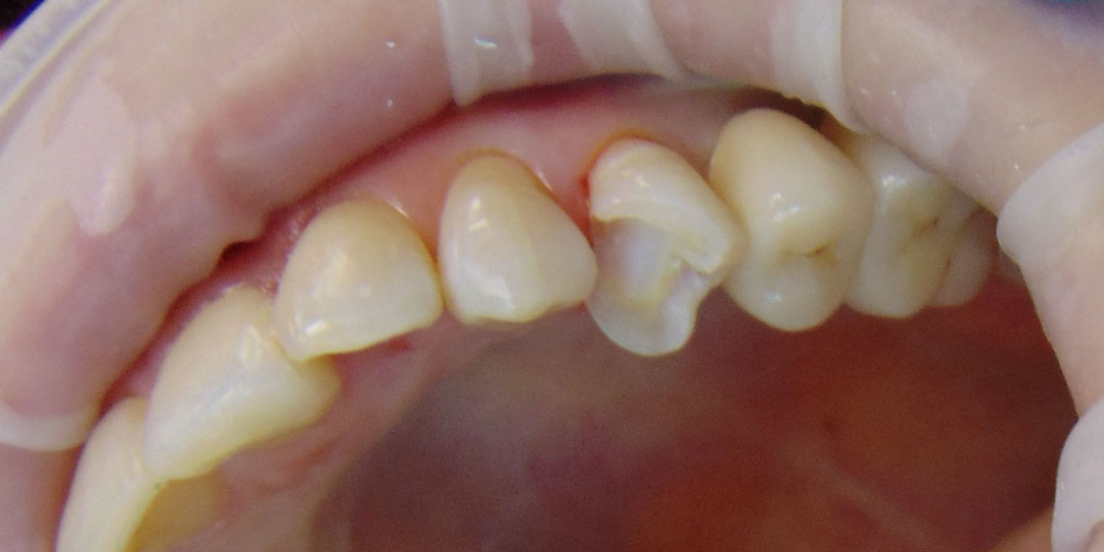 Восстановление зуба с помощью керамической вкладки - фото №1