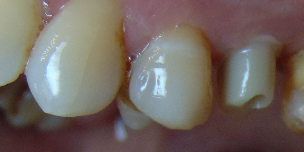 Восстановление зуба с помощью керамической вкладки - фото №3