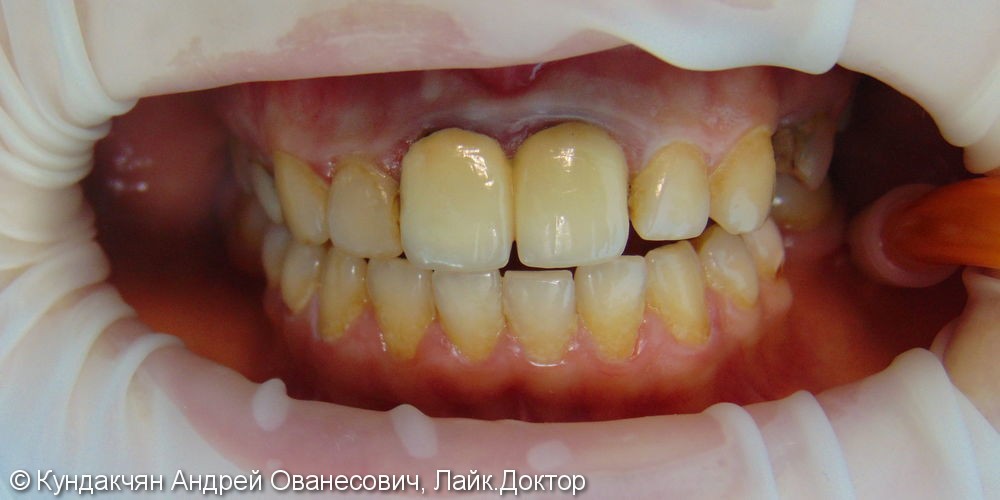 Замена коронок на передних зубах - фото №1