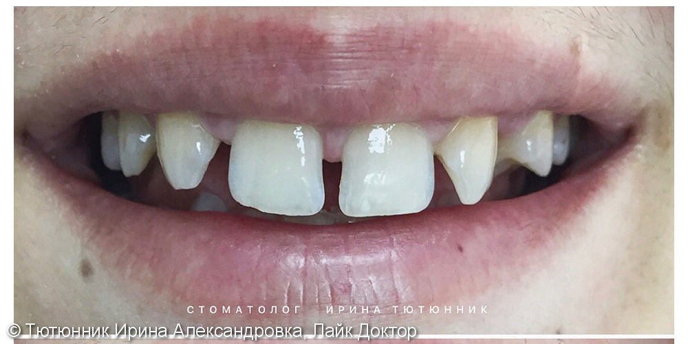 Устранение диастемы и тремы зубов - фото №1
