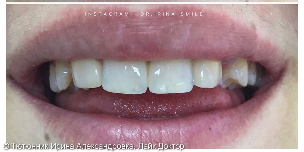 Устранение диастемы и тремы зубов - фото №2