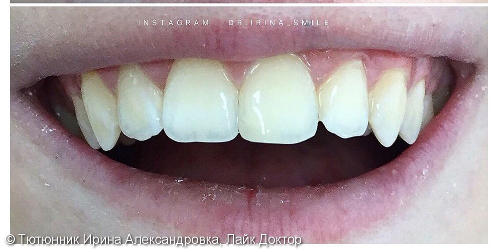Восстановление 2.1 зуба - фото №2