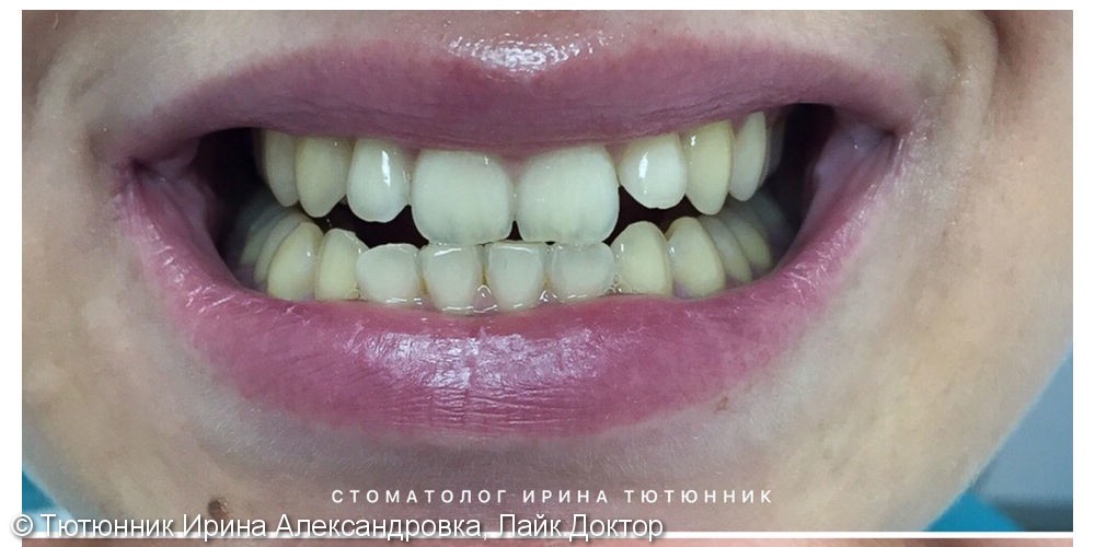 Отбеливание Zoom 4 и реставрация зубов - фото №1
