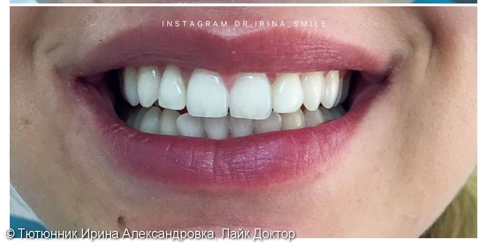 Отбеливание Zoom 4 и реставрация зубов - фото №2