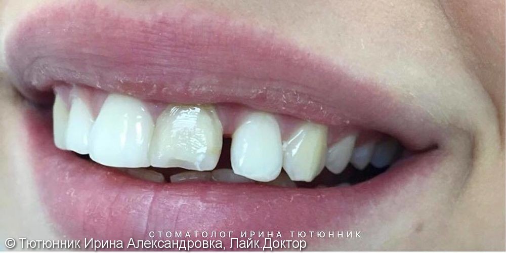 Устранение дисколорита 2.1 зуба и закрытие тремы - фото №1