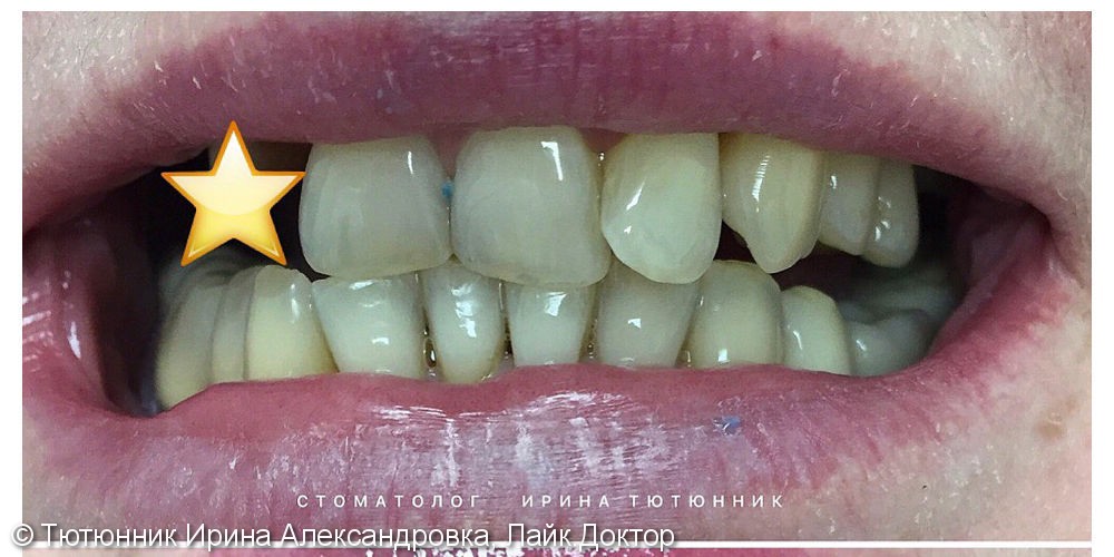 Отбеливание зубов перед протезированием - фото №1