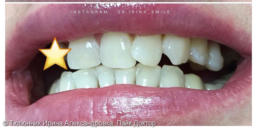 Отбеливание зубов перед протезированием - фото №2
