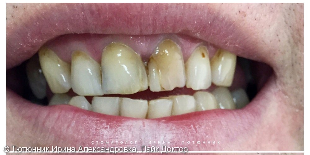 Лечение 4-х фронтальных зубов - фото №1