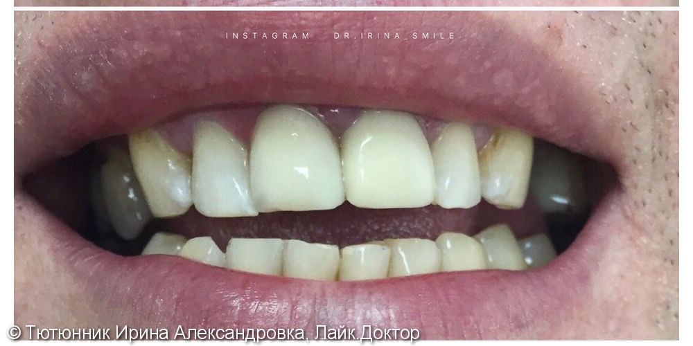 Лечение 4-х фронтальных зубов - фото №2
