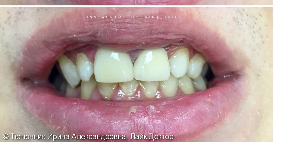 Травма 2-х передних зубов - фото №2