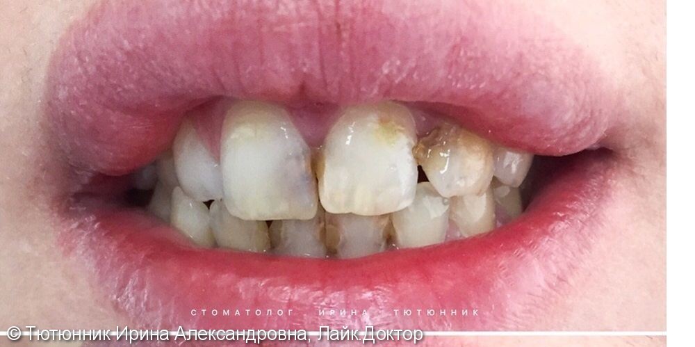 Эстетическая реставрация передних зубов - фото №1