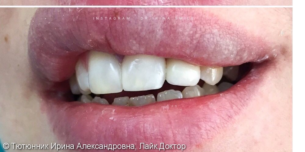 Эстетическая реставрация передних зубов - фото №2
