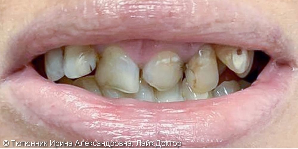 Лечение глубокого кариеса. Исправление формы и положения передних зубов - фото №1