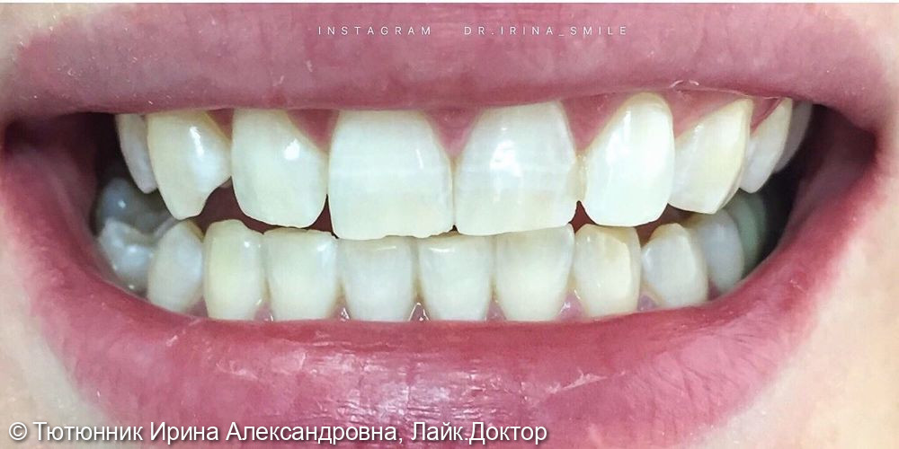 Отбеливание зубов - фото №2