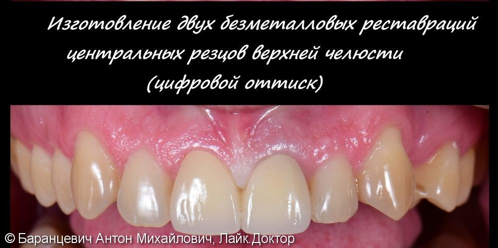 Безметалловые реставрации двух передних зубов, до и после - фото №1