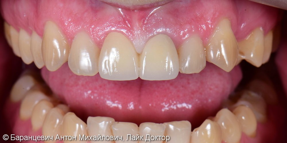 Безметалловые реставрации двух передних зубов, до и после - фото №3