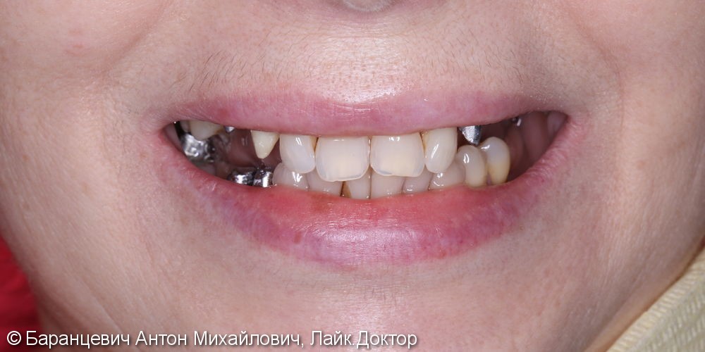 Перепротезирование: Восстановление передних и боковых зубов безметалловыми коронками из диоксида циркония. - фото №1