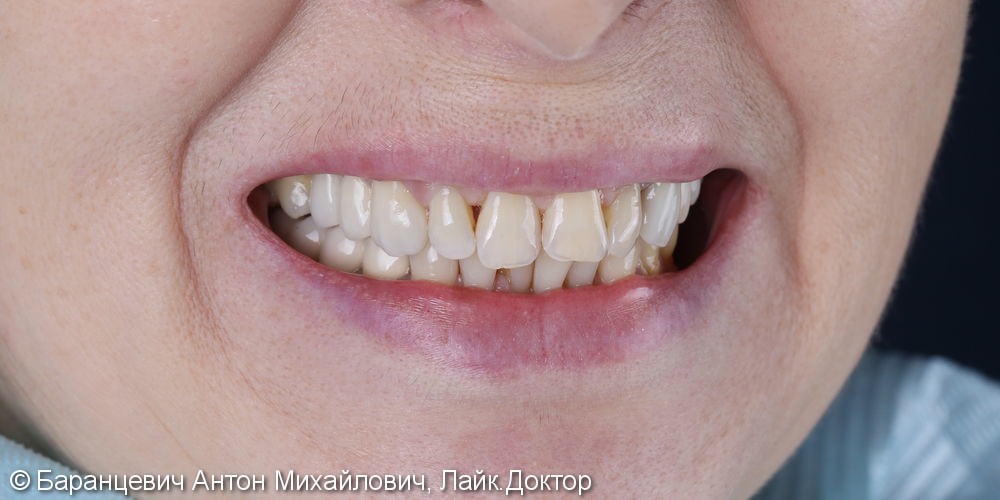 Перепротезирование: Восстановление передних и боковых зубов безметалловыми коронками из диоксида циркония. - фото №2