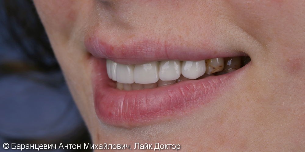 Сохранение и восстановление передних зубов безметалловыми реставрациями (диоксид циркония) - фото №1
