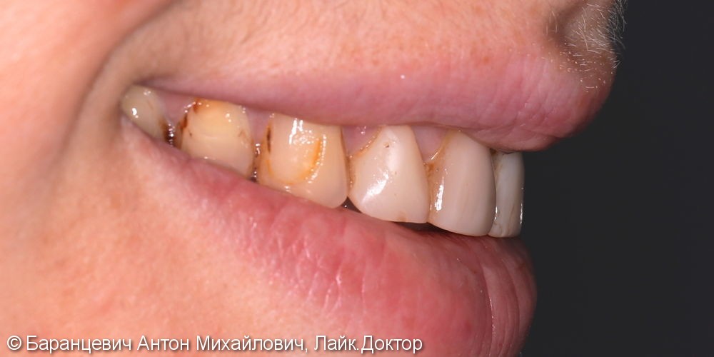 Сохранение и восстановление передних зубов безметалловыми реставрациями (диоксид циркония) - фото №3