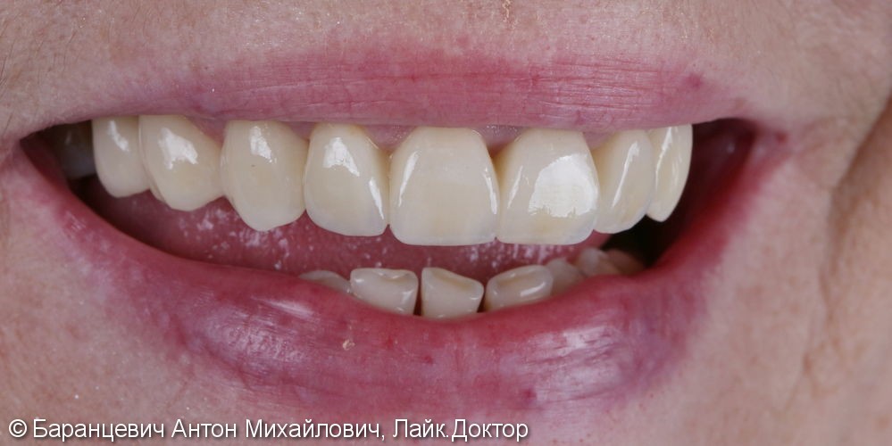 Безметалловые реставрации передних зубов - фото №1