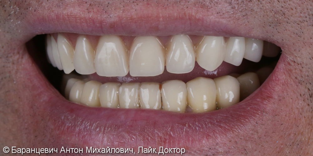 Полное восстановление зубов верхней челюсти - фото №1