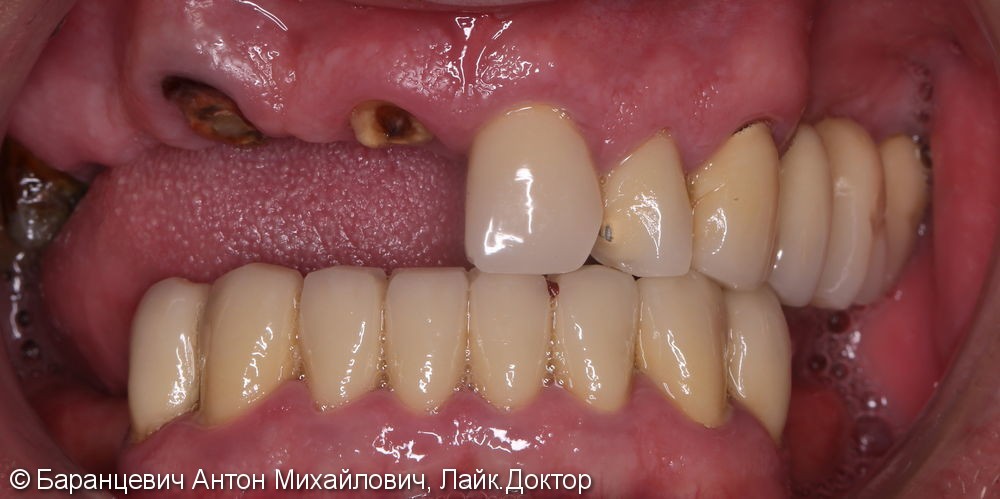 Полное восстановление зубов верхней челюсти - фото №2