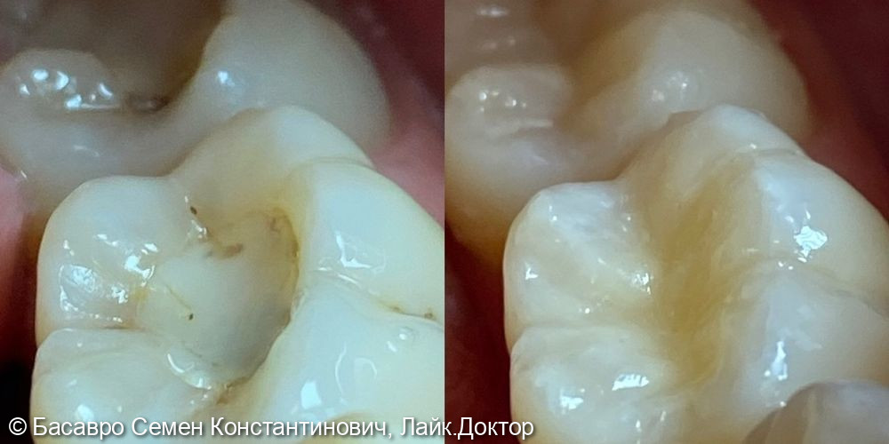 Лечение глубокого кариеса 3.6, 3.7 зубов - фото №1