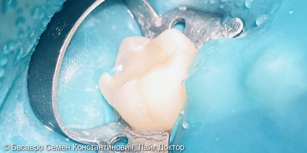 Лечение кариеса зуба 46 зуба - фото №1