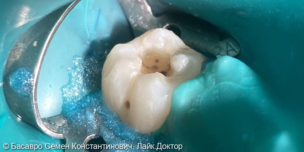 Лечение кариеса дентина 47 зуба - фото №1
