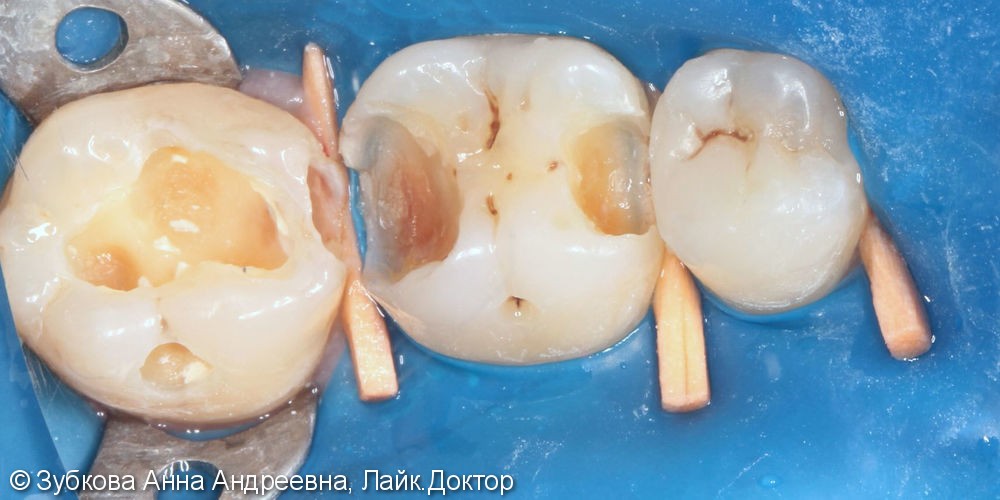 Плановая замена несостоятельных пломб 36 и 37 зубов - фото №2