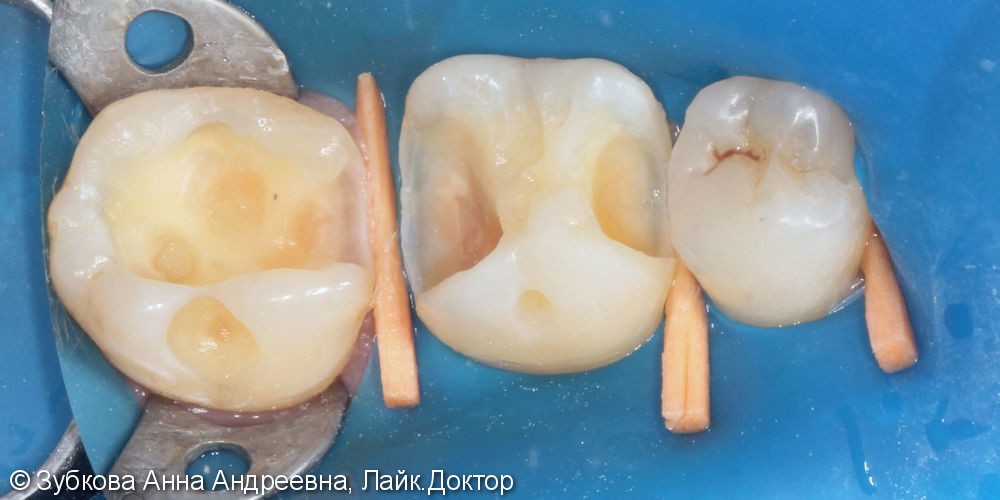 Плановая замена несостоятельных пломб 36 и 37 зубов - фото №3
