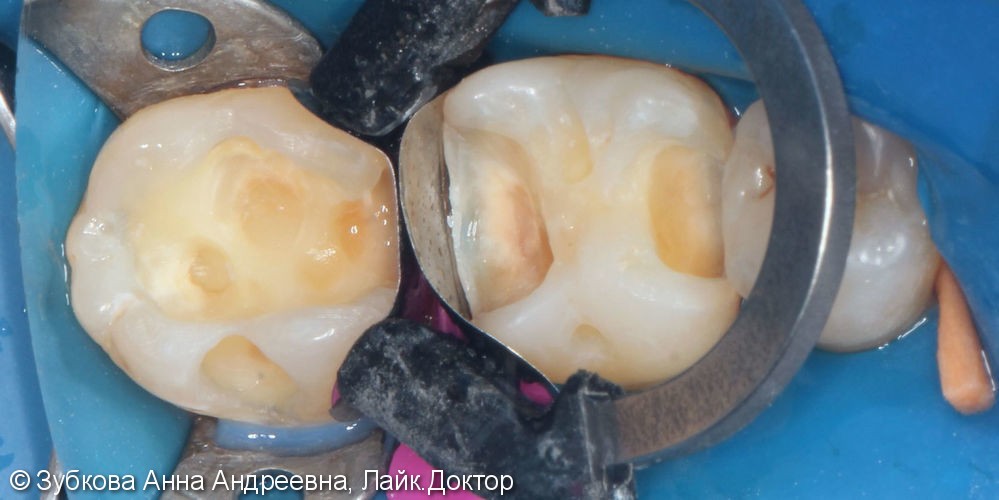 Плановая замена несостоятельных пломб 36 и 37 зубов - фото №4