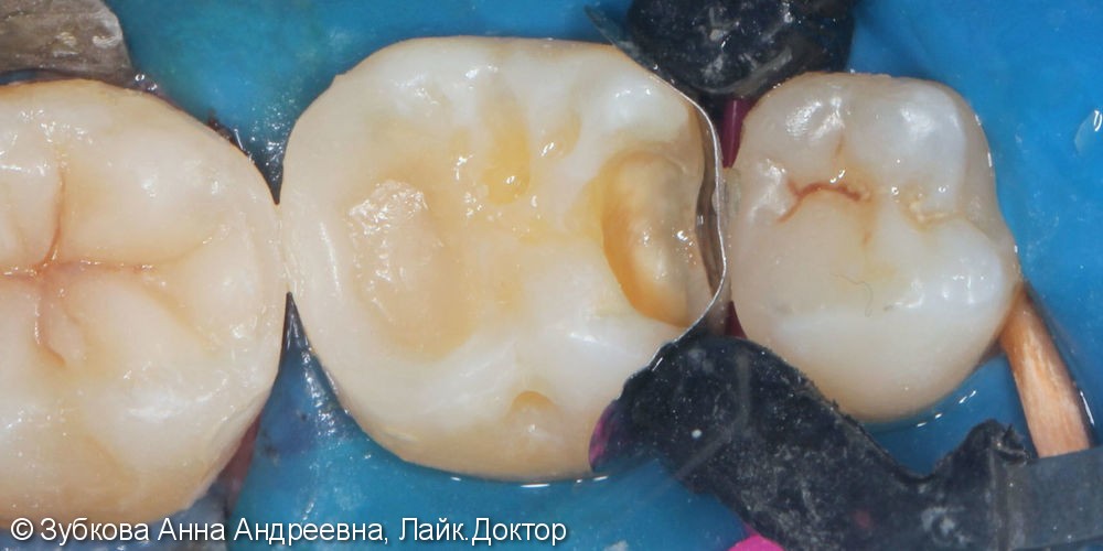 Плановая замена несостоятельных пломб 36 и 37 зубов - фото №5