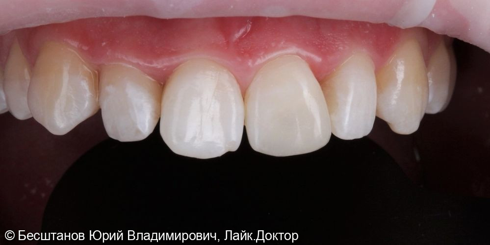 Эстетическая реставрация центрального зуба - фото №1