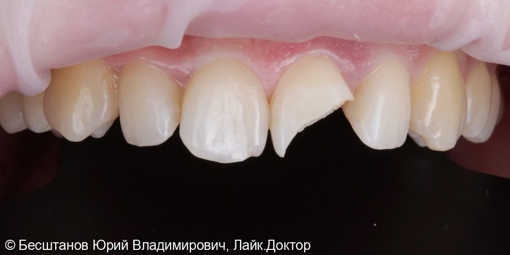 Эстетическая реставрация центрального зуба - фото №2