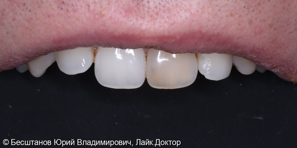 внутриканальное отбеливание центрального зуба - фото №1