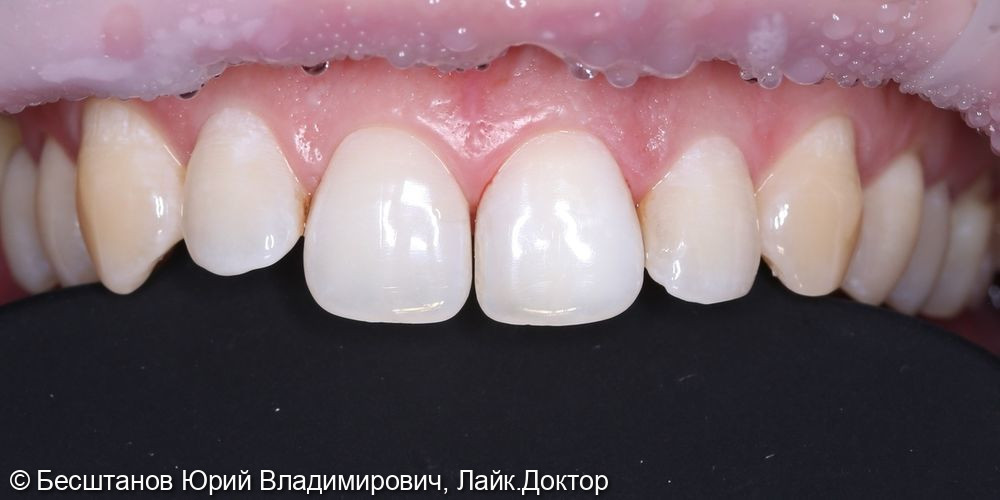 внутриканальное отбеливание центрального зуба - фото №2