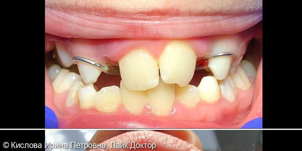 Ортодонтические пластины - фото №1