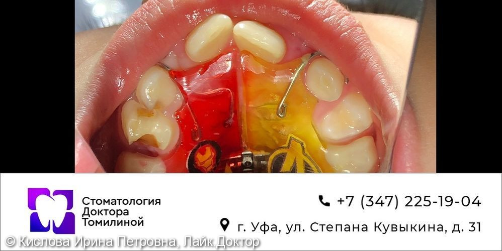Ортодонтические пластины - фото №2