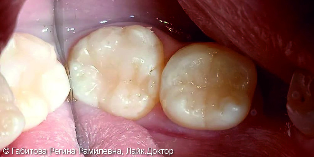 Лечение кариеса жевательных зубов - фото №2